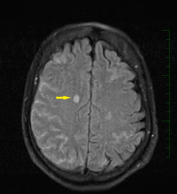 Obr. 3  MR mozku, transverzln ez, ipka znzorujc krvcen