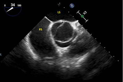 Obr. 4  Vstupn jcnov echokardiografie  pn projekce na nativn bikuspidln aortln chlope. LS  lev s; PS  prav s.