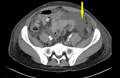 Obr. 5  CT bicha, transverzln ez, ipka oznaujc hemoperitoneum