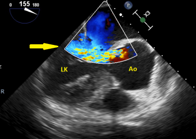 Obr. 8  Jcnov echokardiografie, ipka poukazuje na stedn vznamnou aortln regurgitaci. Ao  aorta; LK  lev komora.