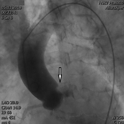 Obr. 2  Invazivn aortografie v lev ikm kraniln projekci: suspektn aortln disekce v oblasti levho koronrnho sinu