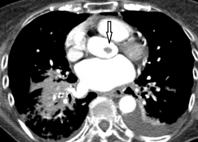 Obr. 3  CT angiografie aorty: tvar v levm koronrnm sinu, nejspe fibroelastom