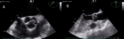 Obr. 4  Jcnov echokardiografie: hypoechogenn mobiln kulovit tvar velikosti 11  12  12 mm s tenkou stopkou. (A) Mid-ezofageln projekce v rovni aortln chlopn  krtk osa. (B). Mid-ezofageln projekce v rovni aortln chlopn  dlouh osa.