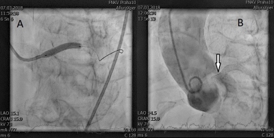 Obr. 5  Implantace kovovho stentu do kmene lev koronrn tepny (ACS) s jeho prominenc do aorty. (A) Roztaen stentu v kmeni ACS. (B) Finln vsledek po perkutnn koronrn intervenci. 