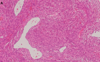 Obr. 5  Histologick obraz odpovd srdenmu angiosarkomu  high-grade. Vetenobunn malign tumor, bohat vaskularizovan, ndorov elementy vykazuj drobn nekrzy, bohat mitotick aktivita. Vzorky zskan pi katetrizan biopsii  barven HE (A), pozitivita v CD31 (B), pozitivita v Ki67 (C). Snmky laskav poskytl MUDr. Martin Syrek, prim Oddlen patologie Nemocnice Na Homolce