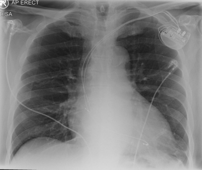 Fig. 3  CXR (AP)  mild cardiomegaly with dual chamber pacemaker in place.