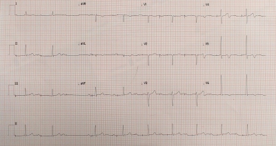 Fig. 2  ECG repeated at 30 minutes.