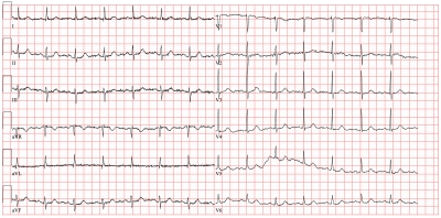 Obr. 2  EKG v odstupu dvou let