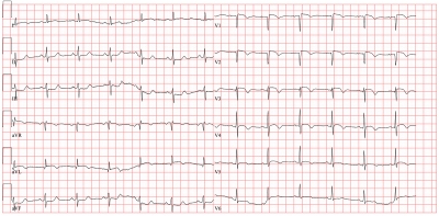 Obr. 1  EKG za hospitalizace s pracovn diagnzou akutnho koronrnho syndromu