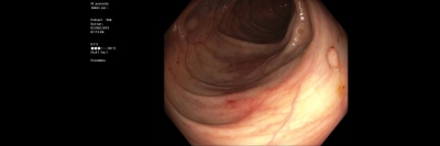 Obr. 2  Koloskopie v oblasti colon transversum  drobn polyp s jinak intaktn sliznic