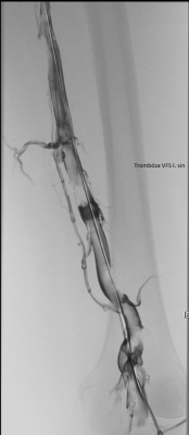 Obr. 3  Vstupn flebografie via s. poplitea vlevo, pln trombotick okluze v. femoralis vlevo