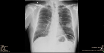 Obr. 1 – Rtg hrudníku po punkci perikardu – tumorózní ložisko levé plíce