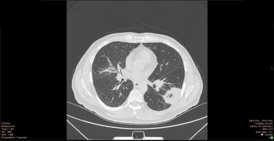 Obr. 4 – CT hrudníku se zobrazeným tumorózním procesem v levé plíci