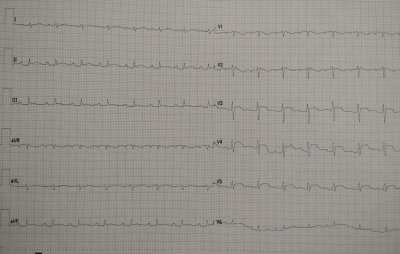 Obr. 5 – EKG při akutních bolestech na hrudi