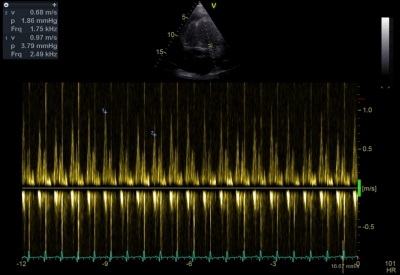 Obr. 1 – Echokardiografie: Pulsní dopplerovská analýza průtoku mitrální chlopní. Přítomna respirační variabilita průtoku o 30 %. 
