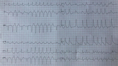 Obr. 1 – Příjmové EKG – elevace úseku ST na přední stěně, blokáda pravého Tawarova raménka staršího data a fibrilace síní 