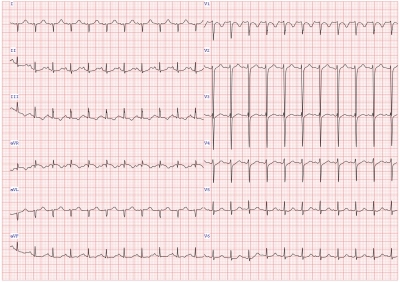 Obr. 1 – EKG se sinusovou tachykardií a vertikálním sklonem srdeční osy