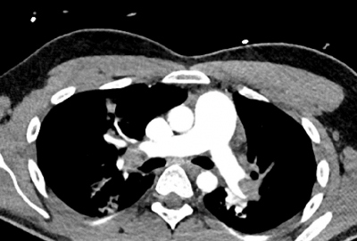 Obr. 3 – Emboly ve větvení plicních tepen. CT dokumentace zveřejněna s laskavostí KZM.