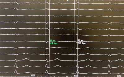 Obr. 1  EKG se selektivn stimulac levho Tawarova ramnka. e komplexu QRS zmena na 98 ms, interval od stimulu k vrcholu kmitu R 83 ms.