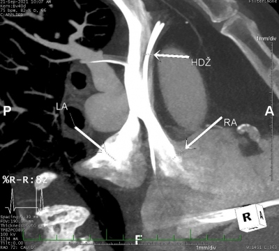 Obr. 2  CT angiografie s prkazem irok komunikace mezi vena cava superior a pravou horn plicn lou stc do lev sn