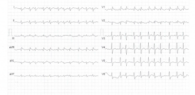 Obr. 5a – Srovnání EKG v úvodu zdravotních obtíží (křivka A) a při diagnóze CP (křivka B). Vidíme nespecifické změny jako sníženou voltáž komplexů QRS a oploštění a inverzi vln T.