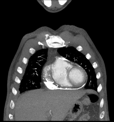 Obr. 2 – CT snímky zobrazující kalcifikace perikardu (A) ve frontální rovině