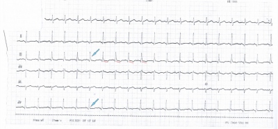 Obr. 5 – Vstupní EKG, končetinové svody, modré šipky ukazují „notch“ ve svodu III a „slurring“ ve svodu aVF, červené čárky naznačují descendentní průběh úseku ST ve svodu III.