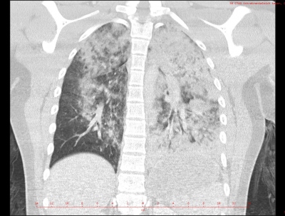 Obr. 4 – CT angiografie plic, rozsáhlá kontuzní ložiska plicního parenchymu