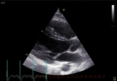 Obr. 12 – Echokardiografické vyšetření – normální velikost srdečních oddílů, bez hypertrofie stěn levé komory
