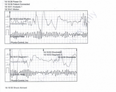 Obr. 1 – Záznam z AED, první analýza, defibrilovatelný rytmus – fibrilace komor
