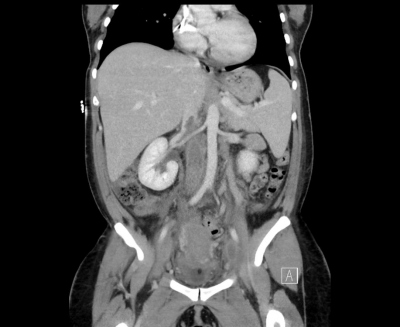 Obr. 1 – Na abdominálním CT je v koronárním řezu zobrazena rozsáhlá trombóza vena cava inferior, proximálně dosahující až nad ústí renálních žil.