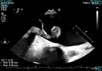 Obr. 4 – Transezofageální echokardiografie. Embolus přesahující z pravé do levé síně přes foramen ovale.  
