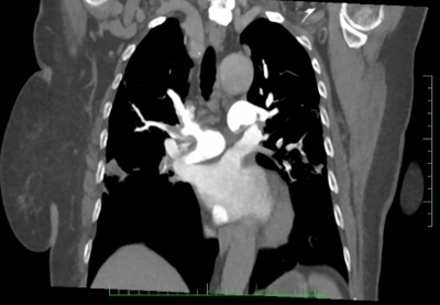 Obr. 2 – CT angiografie plicnice, frontální řez – bilateralní plicní embolie