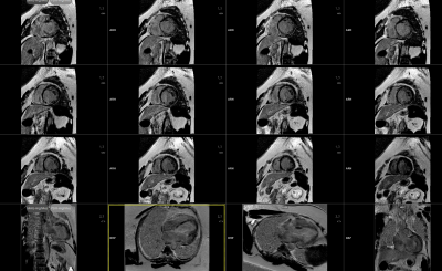 Obr. 2 – Magnetická rezonance srdce s potvrzením dilatace LK s těžkou systolickou dysfunkcí a s jizvením subepikardiálně (segmenty 1, 5, 6, 7, 12), typickým pro pozánětlivý stav