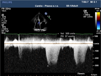 Obr. 4 – Ukázky ultrazvukových parametrů používaných v diagnostickém algoritmu srdečního selhání se zachovanou ejekční frakcí (HFpEF). (A) Měření gradientu na trikuspidální chlopni