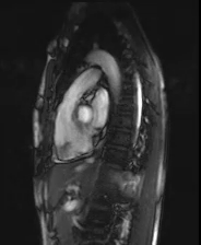 file_5e6a0a5a0ec4a_110_video14_MRI-RV-inflow-outflow1.mp4.mp4