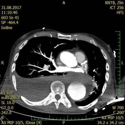 Fig. 1 � Rupture of descending aorta with a right-sided hemothorax.