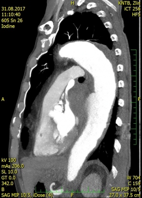 Fig. 2 � Left atrium and pulmonary veins compressed by a mediastinal hematoma.