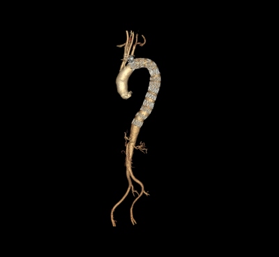 Fig. 3 � Exclusion of affected part of thoracic aorta by three tubular stent grafts.