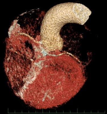 Obr. 3 � CT rekonstrukce proxim�ln�ho �seku koron�rn�ch arteri� s patrn�m extramur�ln�m pr�b�hem