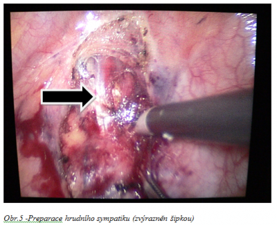 Obr. 5 � Preparace hrudn�ho sympatiku (zv�razn�n �ipkou)
