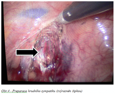 Obr. 4 - Preparace hrudn�ho sympatiku (zv�razn�n �ipkou)