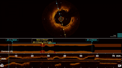 file_5c684cc1350ba_78_Video3_stent_thrombosis_OCT.mp4.mp4