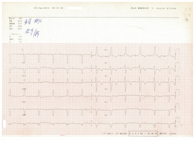 Obr. 1 � EKG p�i pravideln� ambulantn� kontrole � stimulace s�n� s vlastn� komorovou odpov�d�
