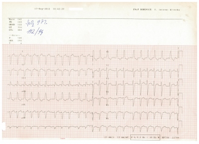 Obr. 2 � B��c� atypick� flutter s�n� s nepravideln�m p�evodem na komory