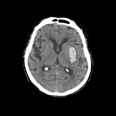 Obr. 1  Vstupn nativn CT mozku