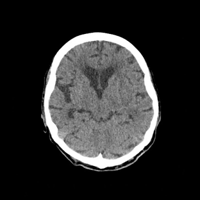 Obr. 3  Kontroln CT mozku za 34 dn