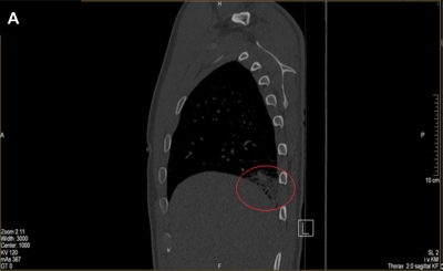 Obr. 2 (A) Sagitln projekce  CTAG: bilaterln stabiln plicn embolizace. Mnohoetn segmentrn defekty v nplni v plicn tkni bilaterln, maximln zmny v dorzobazln oblasti vpravo, kde jsou charakteru plicnho infarktu.