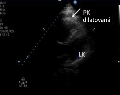 Obr. 2  Modifikovan tydutinov projekce z hrotu, transthorakln echokardiografie, dilatovan prav komora (PK) je vt ne lev komora (LK).
