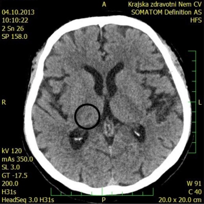 Obr. 2  Kontroln CT druh den hospitalizace  ischemick loisko v oblasti pravho thalamu